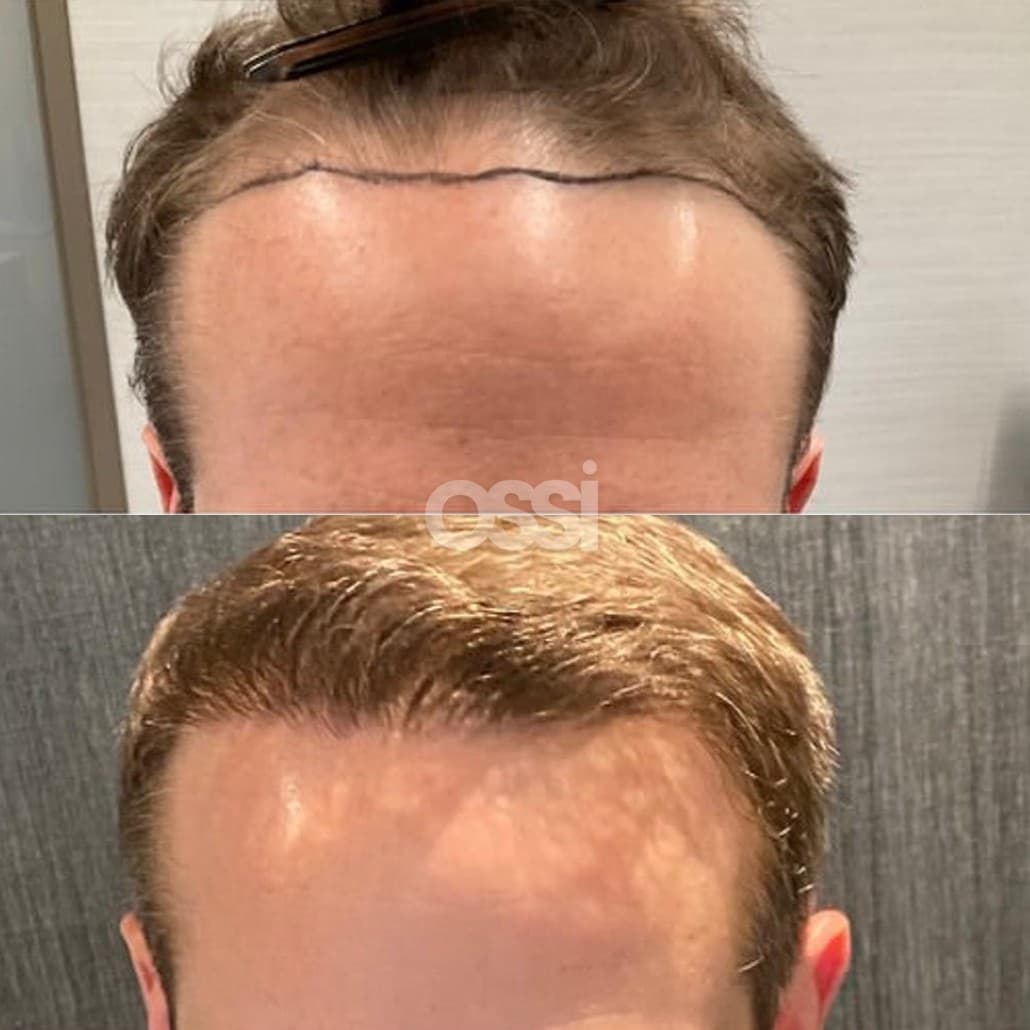 Hair Transplant Case 8