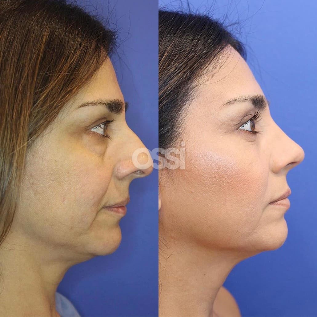Rhinoplasty Case 9