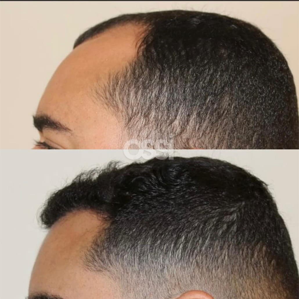 Hair Transplant Case 9