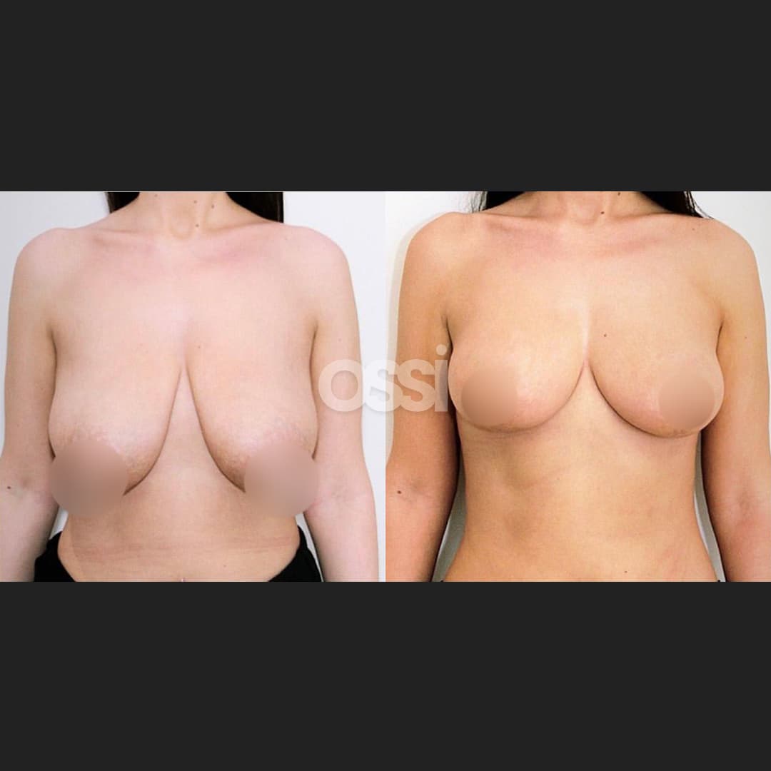 Breast Surgery Case 8
