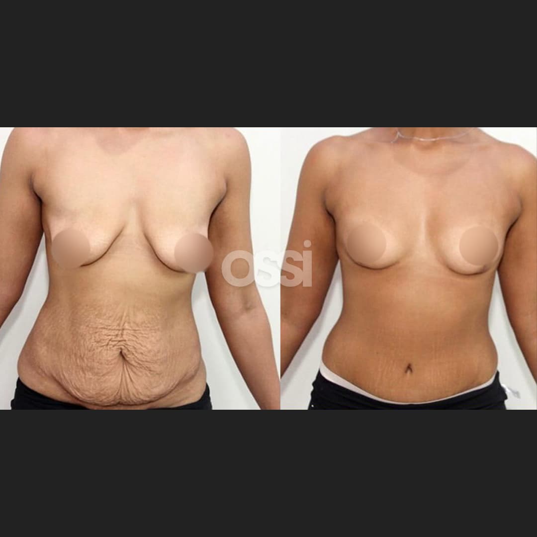 Breast Surgery Case 9
