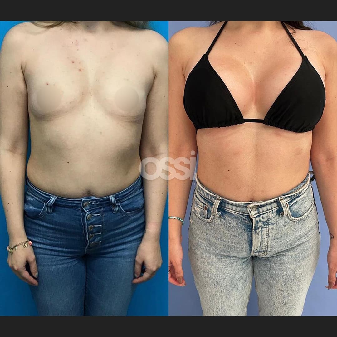 Breast Surgery Case 10